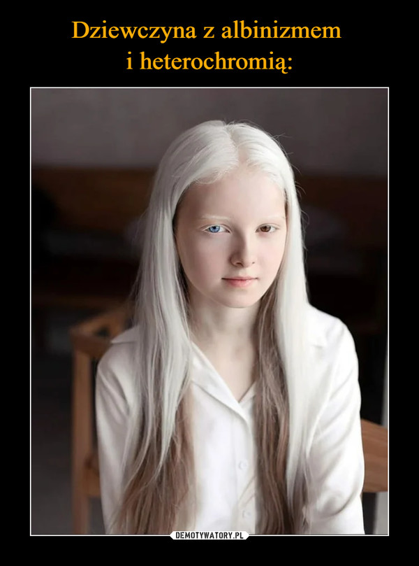 Dziewczyna z albinizmem 
i heterochromią: