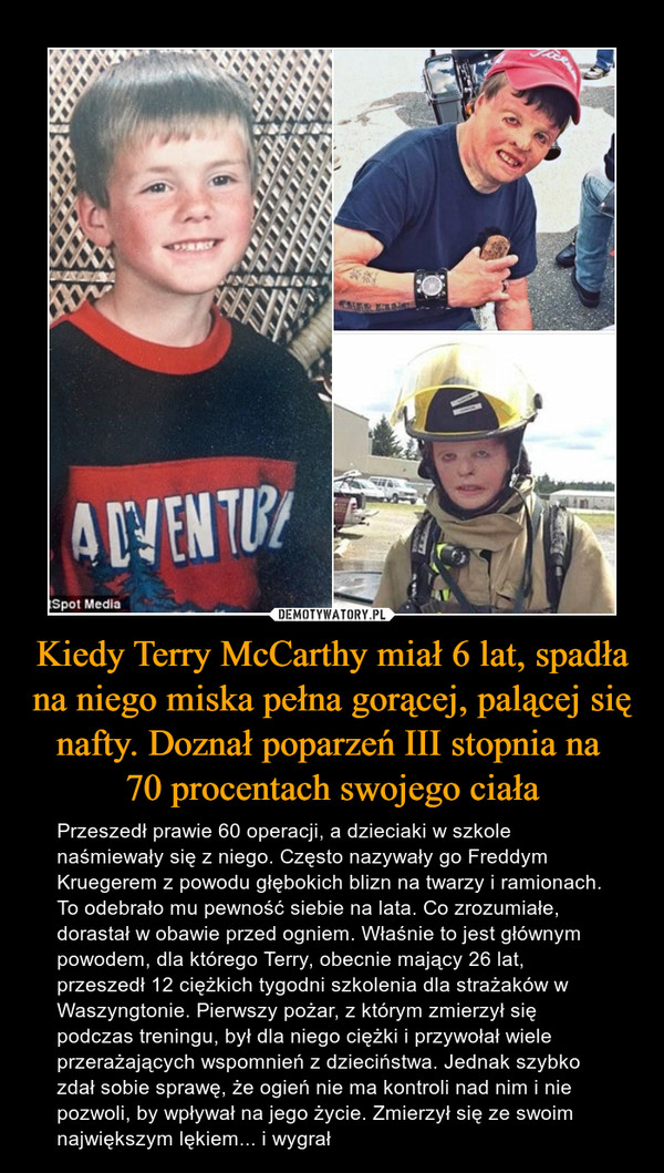 Kiedy Terry McCarthy miał 6 lat, spadła na niego miska pełna gorącej, palącej się nafty. Doznał poparzeń III stopnia na 
70 procentach swojego ciała