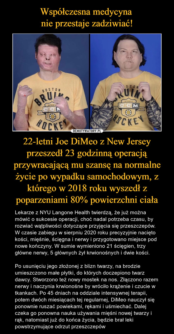 22-letni Joe DiMeo z New Jersey przeszedł 23 godzinną operacją przywracającą mu szansę na normalne życie po wypadku samochodowym, z którego w 2018 roku wyszedł z poparzeniami 80% powierzchni ciała – Lekarze z NYU Langone Health twierdzą, że już można mówić o sukcesie operacji, choć nadal potrzeba czasu, by rozwiać wątpliwości dotyczące przyjęcia się przeszczepów. W czasie zabiegu w sierpniu 2020 roku precyzyjnie nacięto kości, mięśnie, ścięgna i nerwy i przygotowano miejsce pod nowe kończyny. W sumie wymieniono 21 ścięgien, trzy główne nerwy, 5 głównych żył krwionośnych i dwie kości.Po usunięciu jego złożonej z blizn twarzy, na brodzie umieszczono małe płytki, do których doczepiono twarz dawcy. Stworzono też nowy mostek na nos. Złączono razem nerwy i naczynia krwionośne by wróciło krążenie i czucie w tkankach. Po 45 dniach na oddziale intensywnej terapii, potem dwóch miesiącach tej regularnej, DiMeo nauczył się ponownie ruszać powiekami, rękami i uśmiechać. Dalej czeka go ponowna nauka używania mięśni nowej twarzy i rąk, natomiast już do końca życia, będzie brał leki powstrzymujące odrzut przeszczepów 