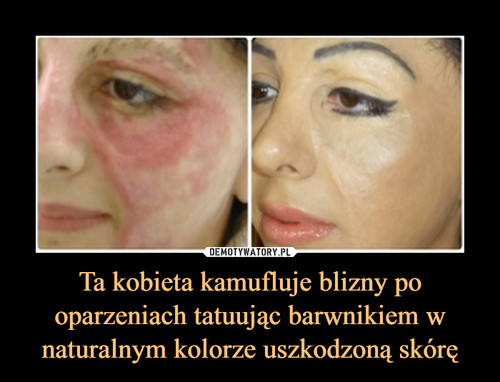 Ta kobieta kamufluje blizny po oparzeniach tatuując barwnikiem w naturalnym kolorze uszkodzoną skórę