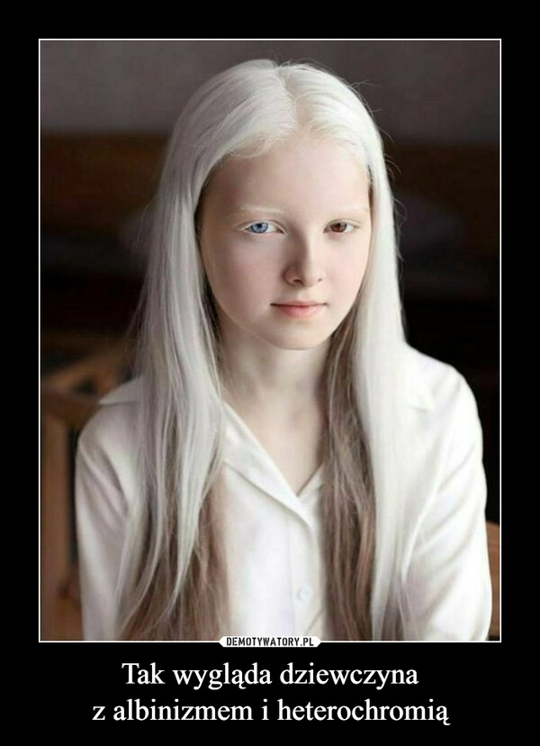 Tak wygląda dziewczyna
z albinizmem i heterochromią