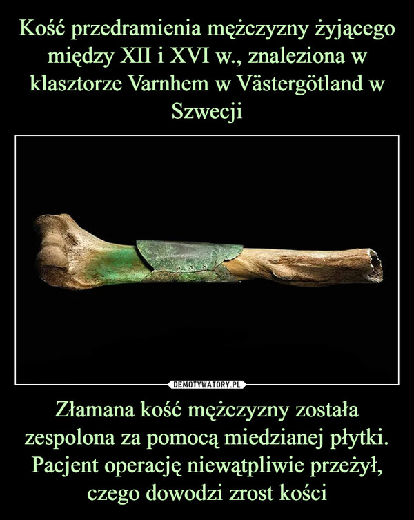 Kość przedramienia mężczyzny żyjącego między XII i XVI w., znaleziona w klasztorze Varnhem w Västergötland w Szwecji Złamana kość mężczyzny została zespolona za pomocą miedzianej płytki. Pacjent operację niewątpliwie przeżył, czego dowodzi zrost kości